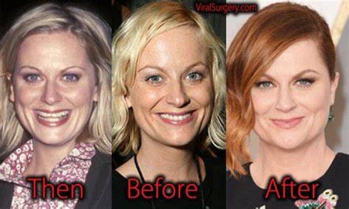 Amy Poehler Plastic Surgery Before and After