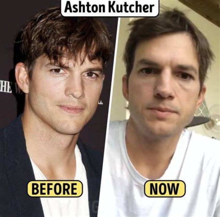 Ashton Kutcher Plastic Surgery Before and After