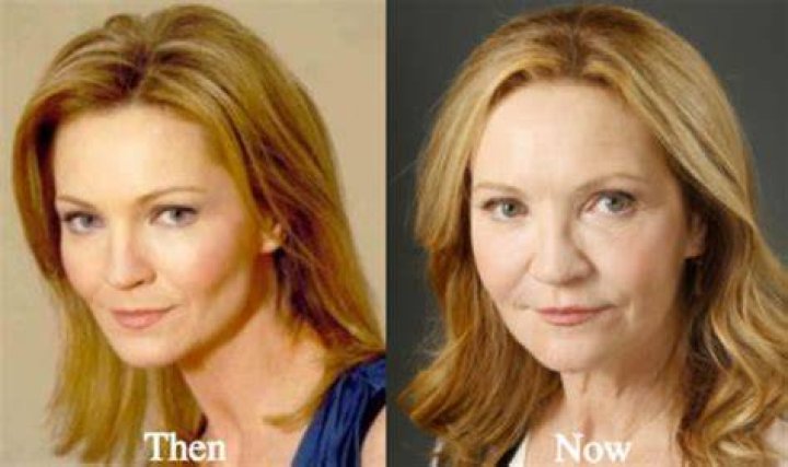 Joan Allen Plastic Surgery Before and After