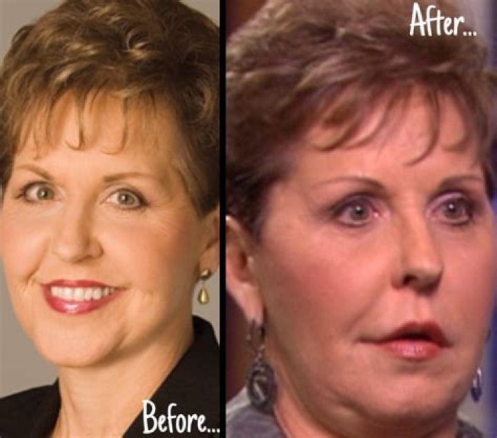 Joyce Meyer Lip Augmentation Plastic Surgery Before and After